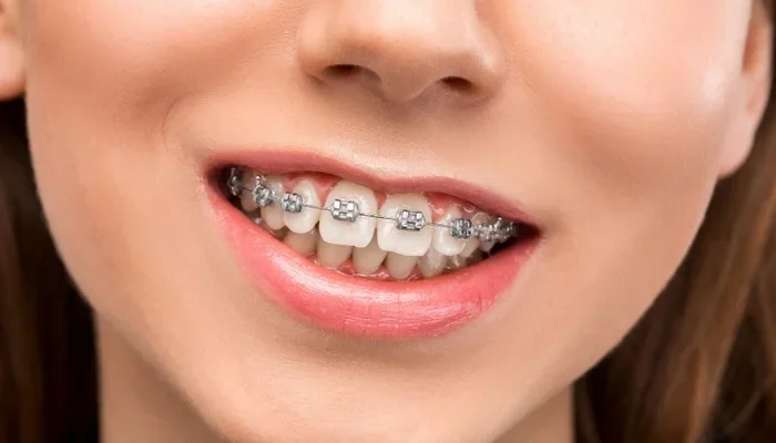 Скільки часу потрібно носити брекети: оптимальний період для результату