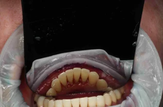 Скільки часу утримуватися від їжі після чистки зубів: поради стоматологів