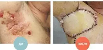 Скільки часу заживають рани після видалення геморою: покрокова інструкція