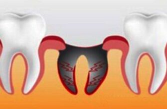 Скільки годин і днів може тривати біль після видалення зуба?