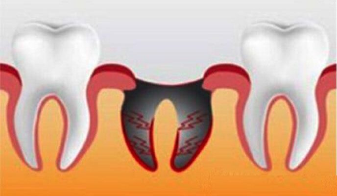 Скільки годин і днів може тривати біль після видалення зуба?