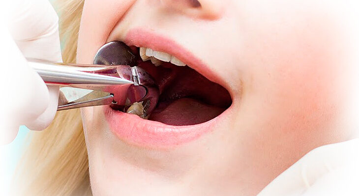 Скільки годин не можна їсти після видалення зуба: поради стоматолога