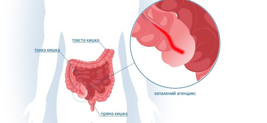Спайки після апендициту: основні симптоми та методи діагностики