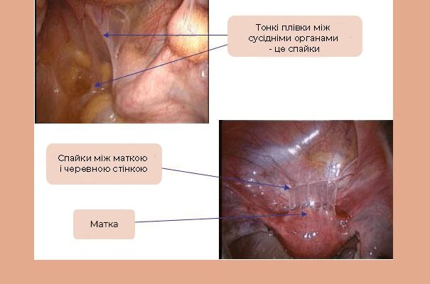 Спайки після лапароскопії: причини виникнення та методи профілактики