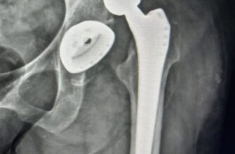 Табу після ендопротезування: що варто уникати для швидкого відновлення