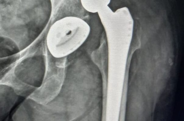 Табу після ендопротезування: що варто уникати для швидкого відновлення