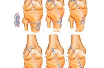 Температура після заміни колінного суглоба: норми та відхилення