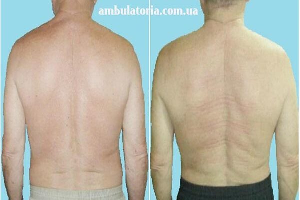 Тривалість болю в спині після вправлення хребців: що очікувати?