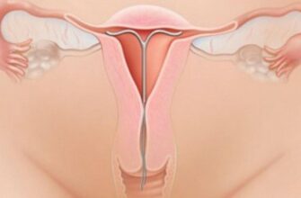 Тривалість кровотечі після встановлення спіралі: скільки це триває?