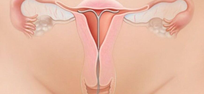 Тривалість кровотечі після встановлення спіралі: скільки це триває?