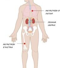 Тривалість життя після видалення ниркової пухлини: скільки років живуть?