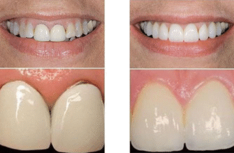 Цирконієві коронки: фото до і після встановлення, переваги та недоліки