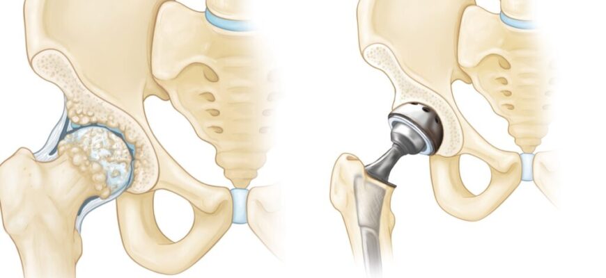 Ускладнення після ендопротезування кульшового суглоба: що варто знати?
