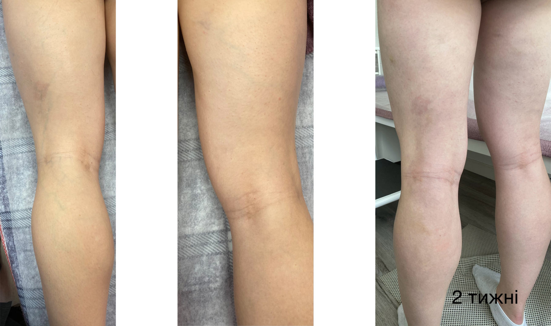 Лазерне лікування варикозу – Видалення варикозу вен лазером, ЕВЛК ...