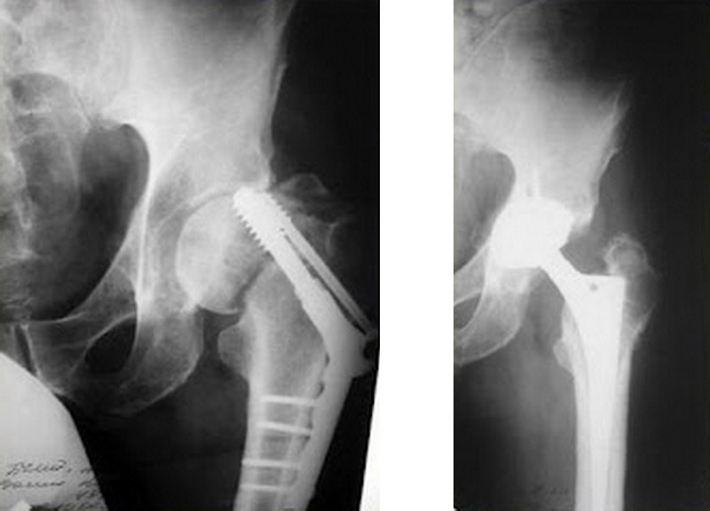 Хибний суглоб (псевдоартроз) – причини виникнення, діагностика ...