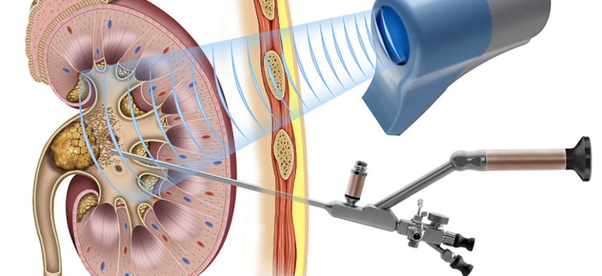 Ускладнення після стентування нирки: причини, симптоми та лікування