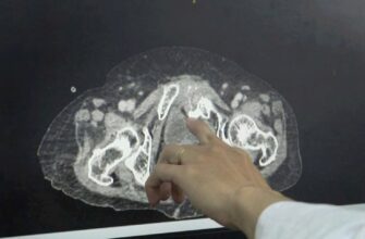 Ускладнення після ТУР сечового міхура: можливі ризики та наслідки