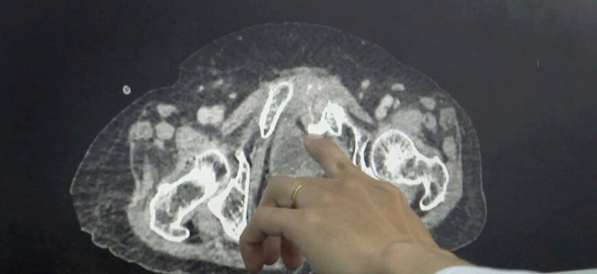 Ускладнення після ТУР сечового міхура: можливі ризики та наслідки