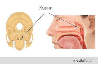 Ускладнення після видалення аденоїдів: діагностика та лікування