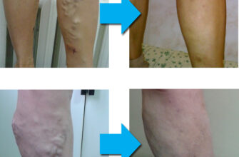 Ускладнення після видалення вен: як уникнути та що робити далі?