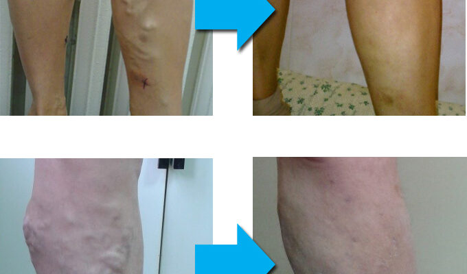 Ускладнення після видалення вен: як уникнути та що робити далі?