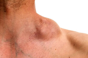 Ускладнення після видалення жировика: причини та методи лікування