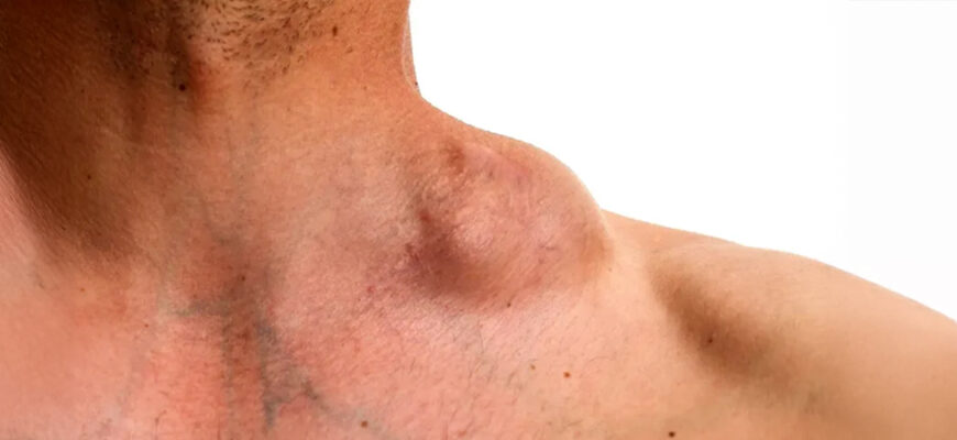 Ускладнення після видалення жировика: причини та методи лікування