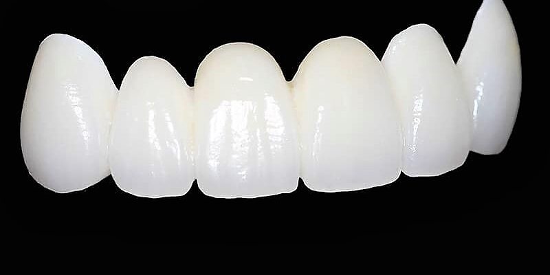 Вартість зняття зубної коронки: скільки коштує процедура в Україні?