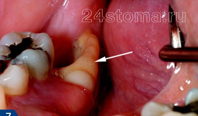 Важливість кров’яного згустку після видалення зуба: догляд і ускладнення