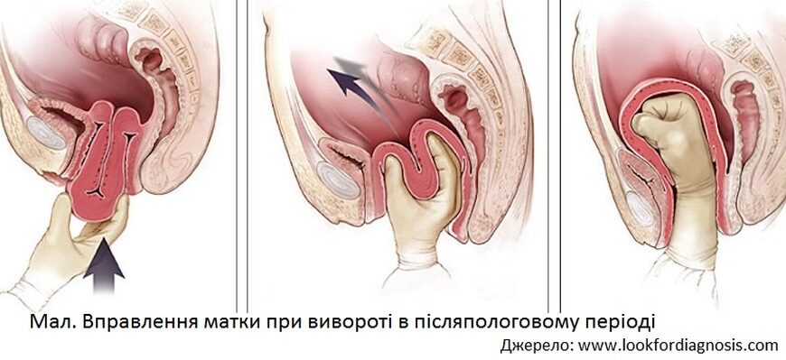 Відновлення матки після пологів: важливі етапи та рекомендації