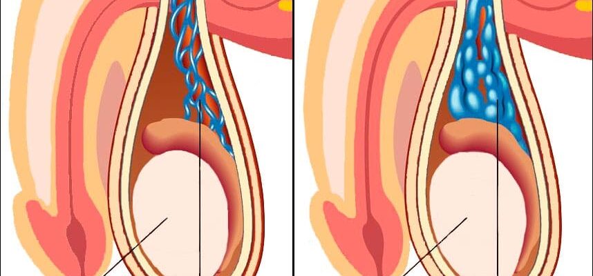 Відновлення після операції варикоцеле: терміни відстрочки та рекомендації Відновлення після операції варикоцеле: терміни відстрочки та рекомендації