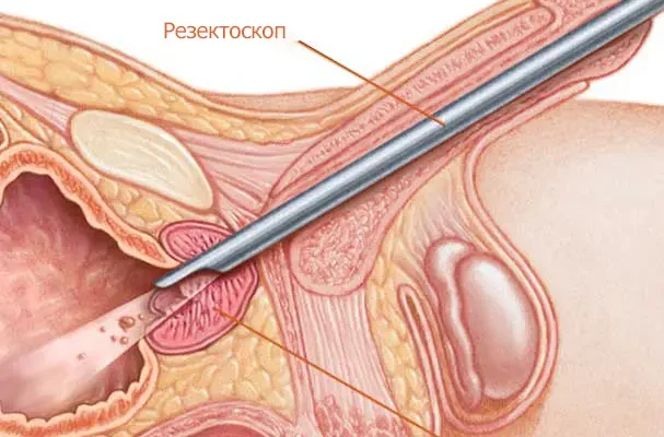 Відновлення сечовипускання після катетера: поради та методи реабілітації