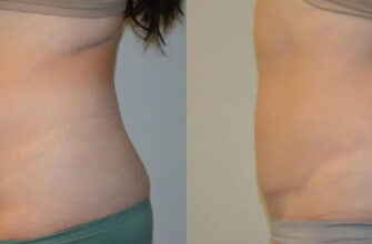 Відновлення живота після кесаревого розтину: ефективні поради та методи