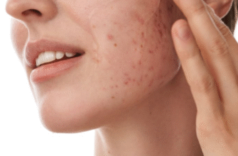 Вплив ретиноїдів на здоров’я: розуміння можливих ризиків і побічних ефектів