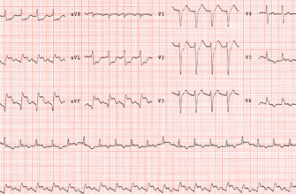 Високий тиск після стентування: причини, симптоми та лікування