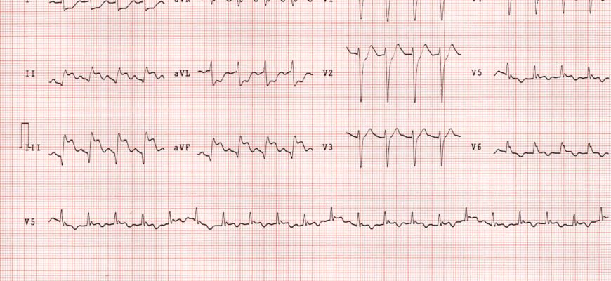 Високий тиск після стентування: причини, симптоми та лікування