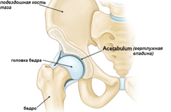 Вивих кульшового суглоба після ендопротезування: причини та лікування