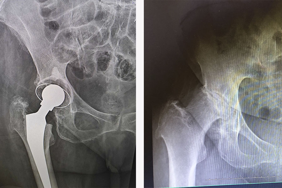 Ендопротезування кульшового суглоба ▷ MEDICAL PLAZA