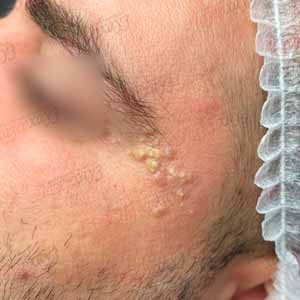 Видалення новоутворень на обличчі в Рівному