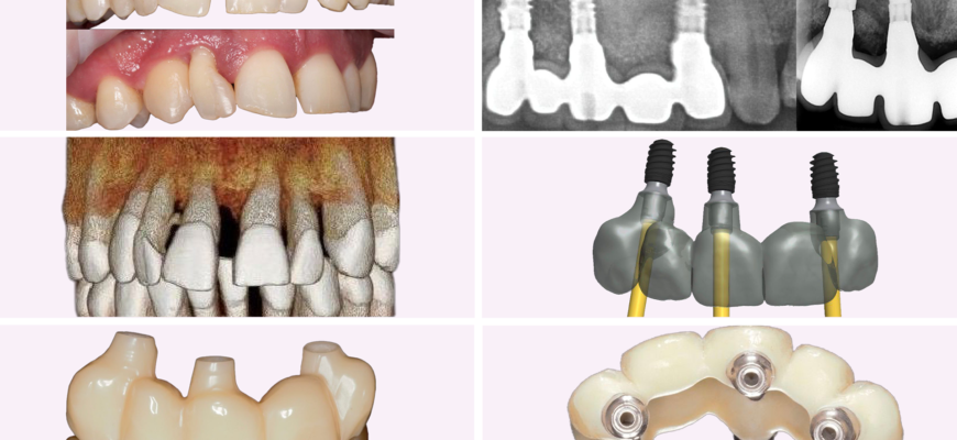 Як доглядати за кісткою після видалення зуба: поради та рекомендації