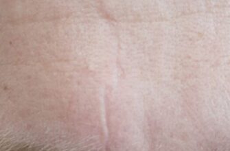 Як доглядати за шрамами після лапароскопії: поради та рекомендації