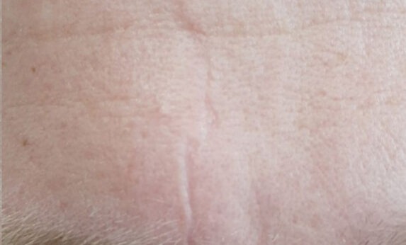 Як доглядати за шрамами після лапароскопії: поради та рекомендації Як доглядати за шрамами після лапароскопії: поради та рекомендації