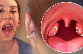 Як ефективно лікувати білий наліт на горлі: поради та засоби