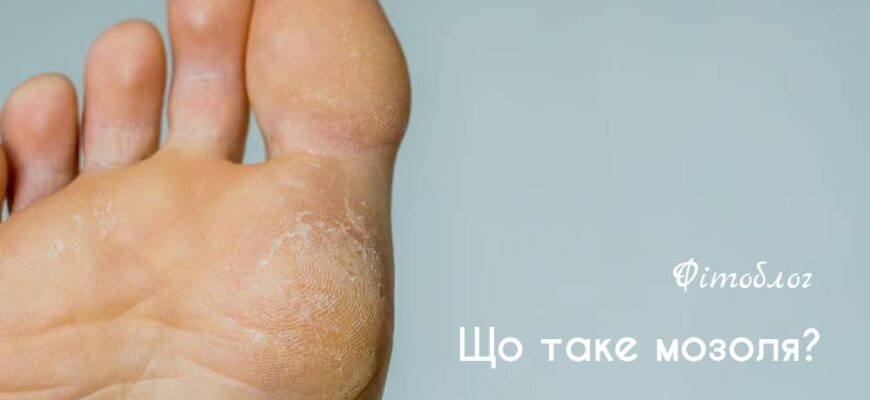 Як ефективно лікувати мозолі на ногах: кращі засоби та рекомендації