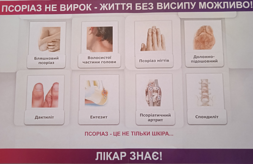 В Центрі Псоріазу ефективно лікують псоріаз новими методами та ...