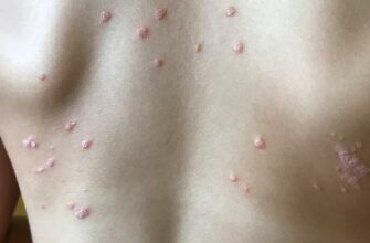 Як ефективно лікувати псоріаз: популярні методи та рекомендації