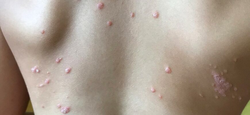 Як ефективно лікувати псоріаз: популярні методи та рекомендації