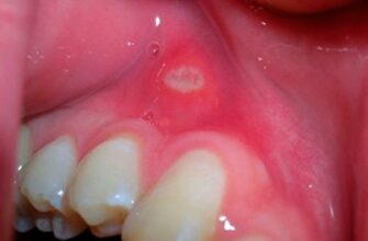 Як ефективно лікувати рани в роті вдома: поради та засоби