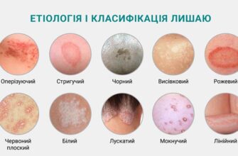 Як ефективно лікувати рожевий лишай: найкращі мазі та креми