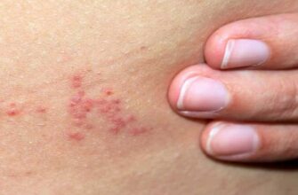 Як ефективно лікувати укуси клопів: поради та засоби для полегшення симптомів